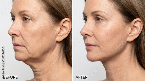 Woman Before and After Anti-Aging Treatment - Neck and Jawline Rejuvenation