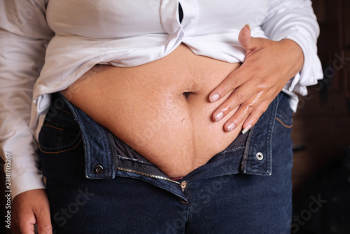 A Bolivian Latina woman's stomach with postpartum stretch marks - the concept of motherhood