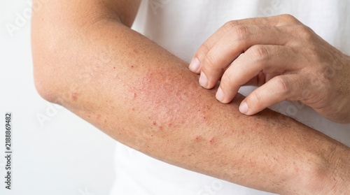 Close-up of a person scratching a red, irritated skin rash with small bumps and scabs on their forearm against a white background.