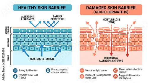 Healthy skin barrier chart contrasting smooth protective layers against a damaged reddish atopic dermatitis structure with moisture loss.