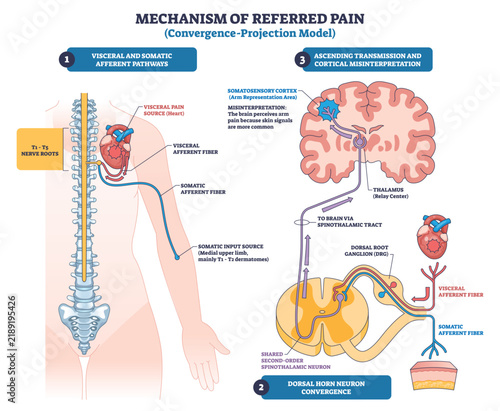 Referred pain convergence projection, visceral and somatic inputs meet in dorsal horn, ascend to thalamus-cortex, brain maps heart pain to arm. Key objects, spinal cord, heart, brain. Outline diagram
