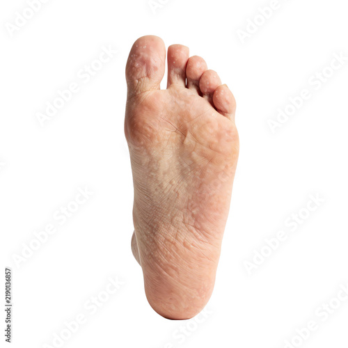 Close-up of a human foot showing dry skin and blisters on toes and sole