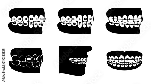 Dental braces before and after comparison silhouettes