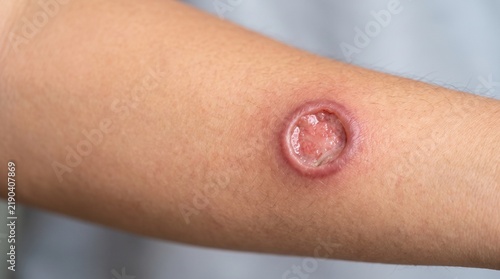 Healing cutaneous leishmaniasis skin ulcer on forearm, close-up medical photograph
