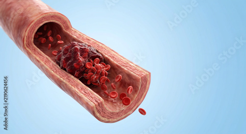 3D medical illustration of the human 3D blood clot in artery, isolated against light blue background with copy space