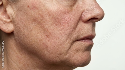 Visible blemishes and rough skin texture indicating ageing and diet-related skincare concerns.