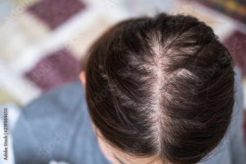 Bild auf Leinwand Top of the head of young Asian woman after facing hair loss problem