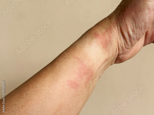 Close-up of red allergic skin rash and idiopathic dermatitis inflammation on a human wrist. Ideal for medical, healthcare, dermatology, and allergic reaction concepts.