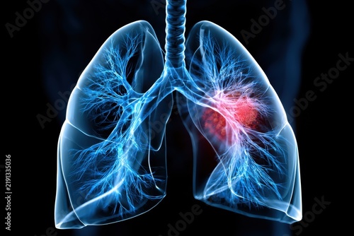 Detailed 3d rendering of human lungs with blue airway structures and highlighted red area indicating inflammation or disease in respiratory system anatomy