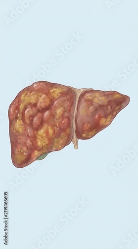 Damaged hepatic organ: liver disease, viral hepatitis, chronic cirrhosis, severe inflammation, fatty steatosis, tissue fibrosis, cellular damage, medical concept, human anatomy, internal problem.