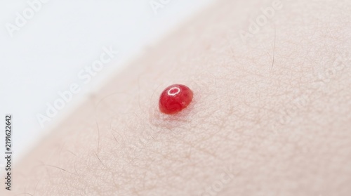 Macro shot of a bright red cherry angioma or senile angioma on pale human skin