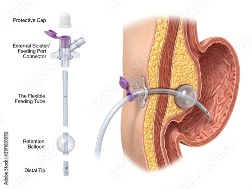 Percutaneous Endoscopic Gastrostomy PEG Feeding Tube Exploded View With Stomach Anatomy