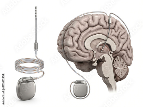 Deep Brain Stimulation DBS System Diagram Showing Neurostimulator Implant And Electrode Placement