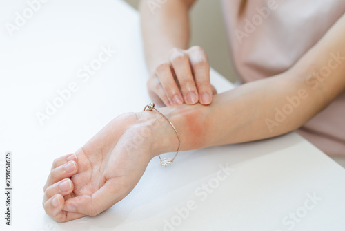 red rash on the skin from allergy, jewelry. Close-up red rash on the wrist.