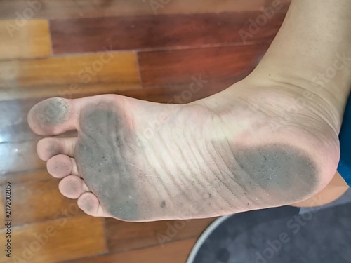 Fotografía Dirty Bare Foot Sole with Dry Callused Skin