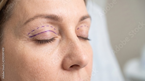 Eyelid blepharoplasty marking line on woman eye before surgery. Precise eyelid blepharoplasty surgical planning ink on skin.