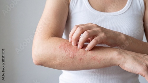 Close-up of a person's arm showing red rash and irritation, indicating an allergic reaction or skin condition