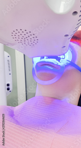 Fotografie Professional teeth whitening session featuring a blue LED acceleration lamp and a mouth retractor in a dental clinic