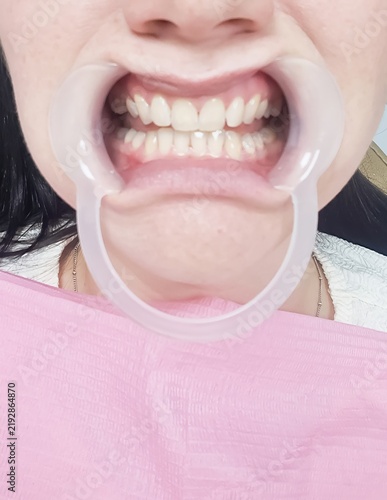 Foto A patient showing clean white teeth using a cheek retractor after a dental white