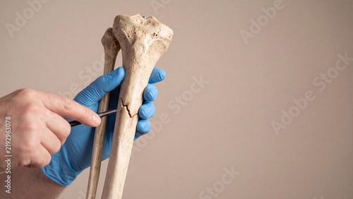 Bone fracture examination concept for orthopedic injury diagnosis and skeletal medical education