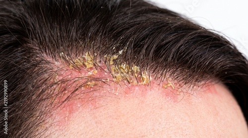 Close-up view of seborrheic dermatitis on a person's scalp and hairline showing red inflammation and yellow crusty flakes.