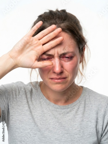 Young woman with red, irritated eyes crying and holding her hand to her forehead, suffering from an eye infection or allergy.