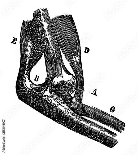 Bild auf Leinwand Vintage medical engraving of an elbow dislocation labeled