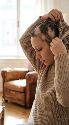 Autoimmune scalp disorder: alopecia areata, baldness pattern, female patient, tie kerchief, cover head, hair shedding, emotional acceptance, dermatology treatment.