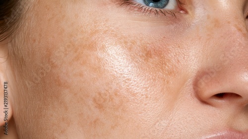 hyperpigmentation woman face