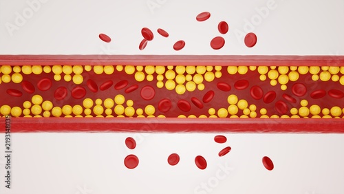 Bild auf Leinwand Cross section of blocked artery with cholesterol plaque and red blood cells 3d r