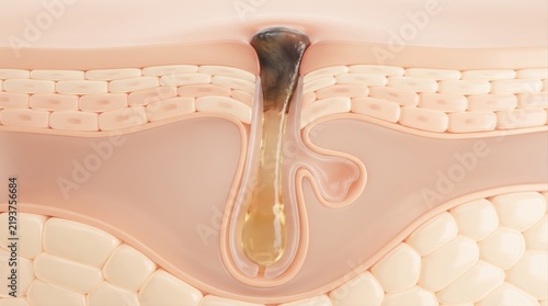 A cross-section illustration of human skin revealing an open comedone inside a hair follicle pore.