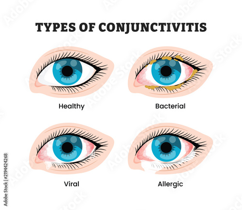 Different types of conjunctivitis labeled diagram, educational medical poster design healthcare scheme, healthy bacterial viral and allergic eye comparison. Labeled conjunctival redness and discharge