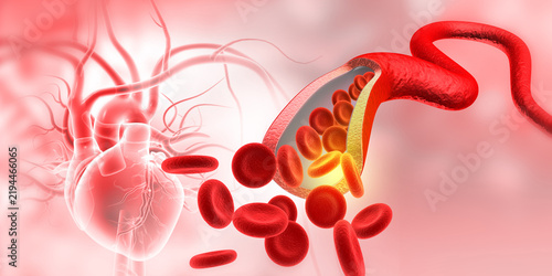 Human heart anatomy displaying a severely clogged artery with cholesterol plaque build-up