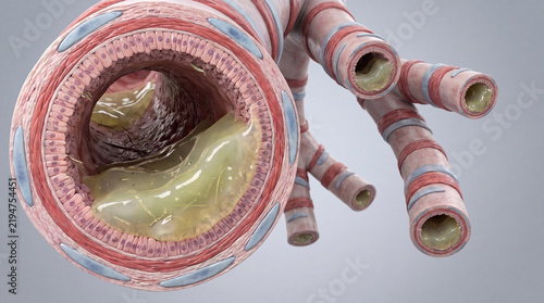 Cross Section of Bronchiole With Mucus Plugging in RSV Infection