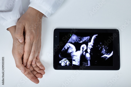 Quadro su tela Obstetrician gynecologist holding hands near a digital tablet screen displaying a third trimester fetal ultrasound scan