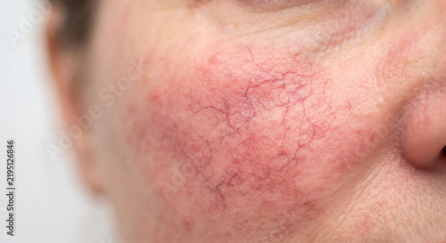 Rosacea Skin Texture: Close-up of human skin displaying redness and visible blood vessels, characteristic of rosacea or sensitive skin, highlighting dermatological condition.