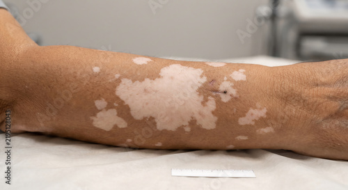 Vitiligo on Arm: Close-up of a human arm exhibiting depigmented patches characteristic of vitiligo, showcasing skin texture and the distinct contrast between affected and unaffected areas.