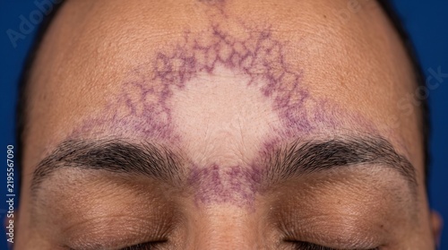 Close up of port-wine stain birthmark, vascular malformation or telangiectasia condition on patient forehead, dermatology concept