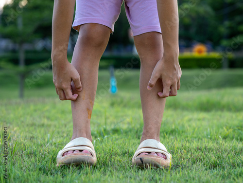 Low section of child standing on grass bending down to scratch itchy insect bites on both legs