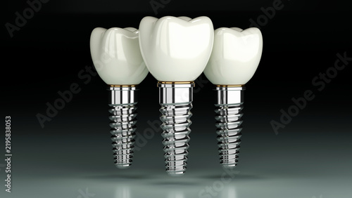 Fotografie 3D rendering of dental implant structure, medical teeth implant, design of denti