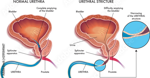 A medical illustration comparing a normal urethra with one affected by a stricture, along with the associated consequences.

