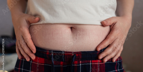 Close-up of a woman touching elastic waistband marks on her stomach skin. Tight clothing imprint caused by uncomfortable waistband and skin pressure.