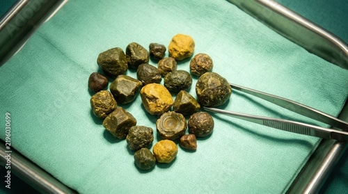 Surgical Gallstones Removed From A Patient On A Medical Tray