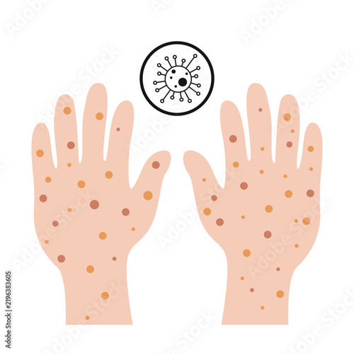 Hand allergy skin itchy rashes medical illustration icon design vector