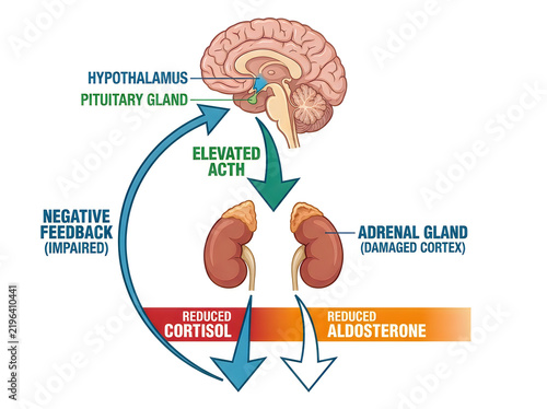 Addison Disease Pathophysiology Medical Infographic Showing Adrenal Insufficiency Reduced Cortisol Aldosterone and Elevated ACTH Diagram