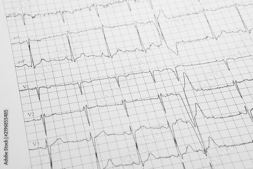 Close-Up of Electrocardiogram Tracing on Medical Grid Paper. Detailed close-up of an ECG printout showing multiple cardiac waveform leads on grid paper for heart rhythm monitoring and medical analysis