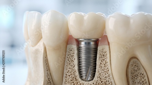 Modelo 3D de implante dentário de titânio no osso maxilar com coroa de porcelana. Conceito de anatomia, cirurgia odontológica e prótese