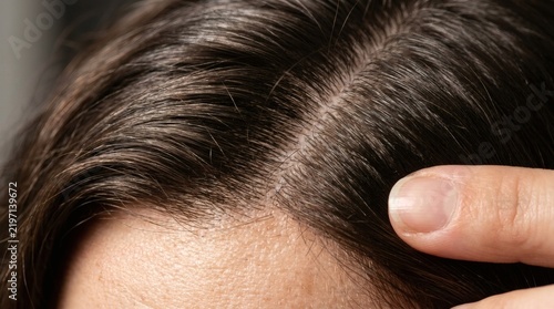 Close up of human scalp showing dark hair and skin condition