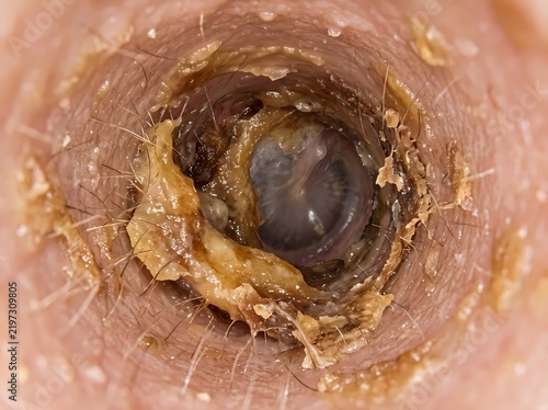 Endoscopic view of human ear canal showing cerumen earwax buildup and tympanic membrane eardrum