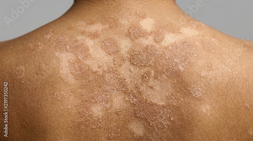 Macro view of a human back covered in severe scaly red plaques, symptomatic of psoriasis, eczema, or a widespread dermatitis condition.